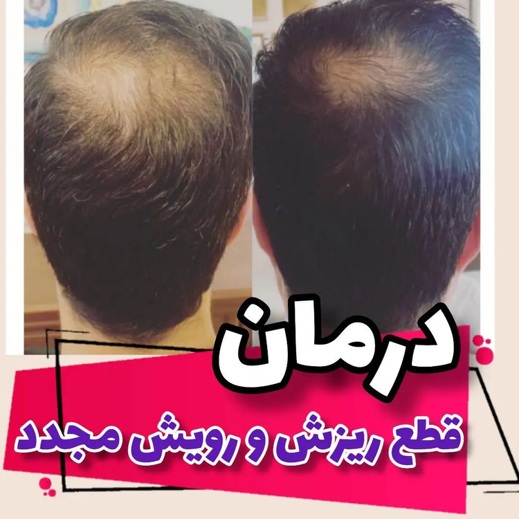 تونیک ضدریزش و تقویت مو هیرفرند300 میلی لیتر100درصد گیاهی و اورجینال* تخفیف ویژه به مدت محدود*